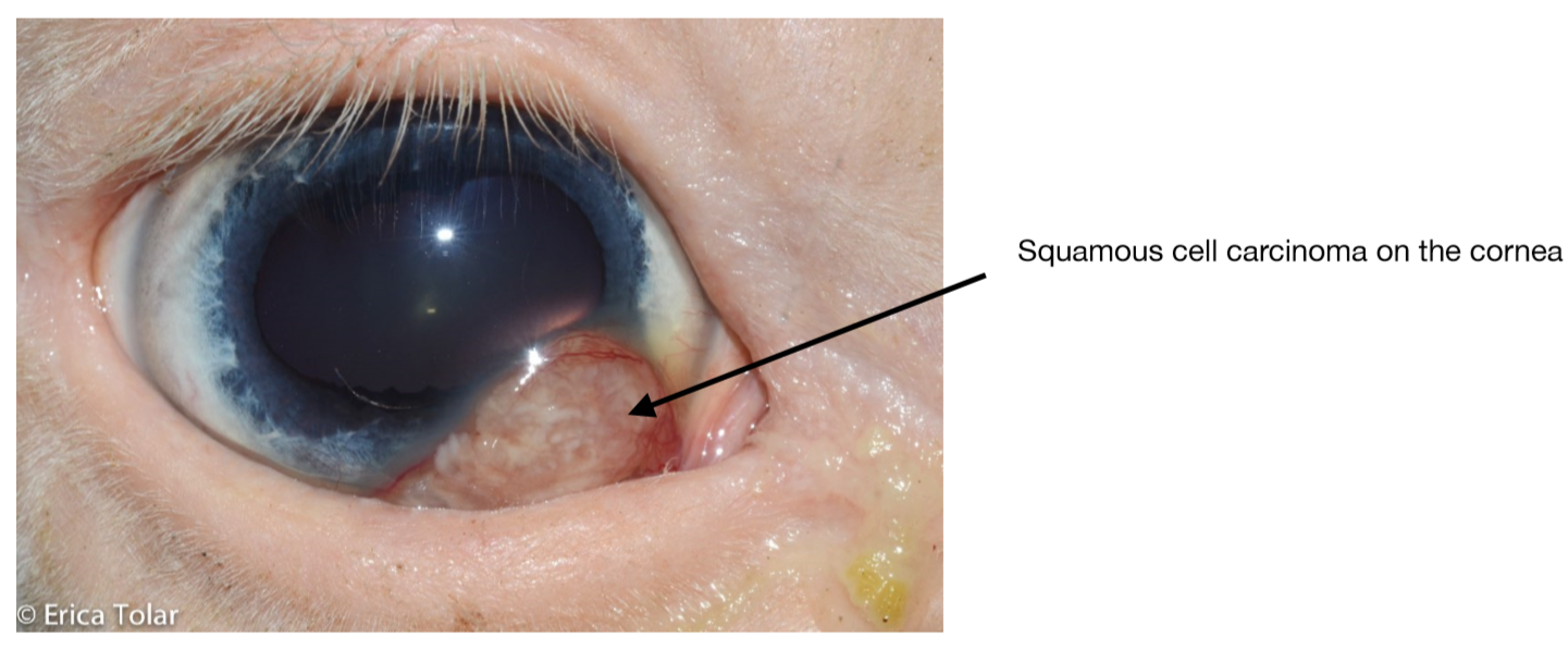 Squamous Cell Carcinoma