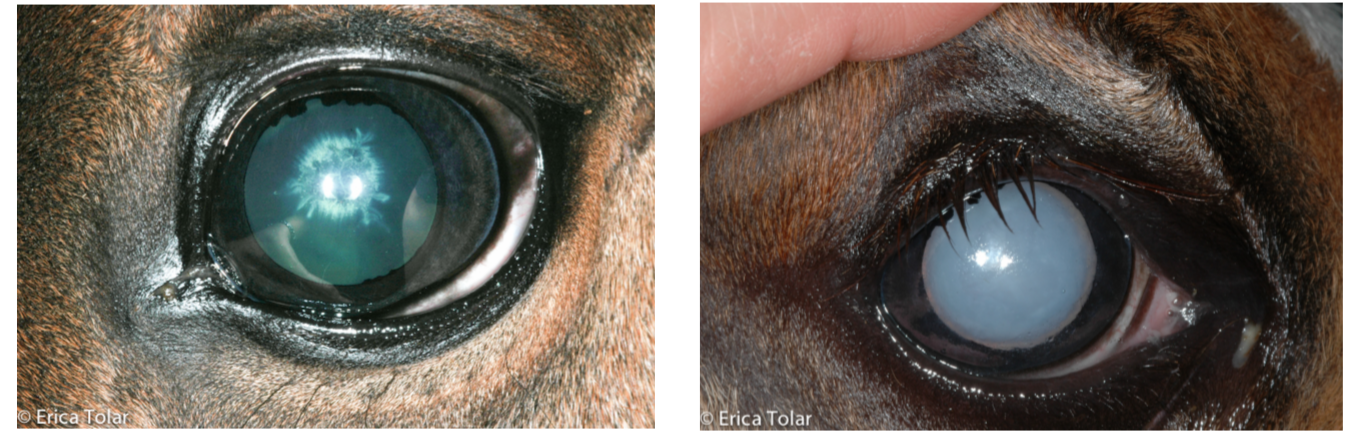 Cataracts